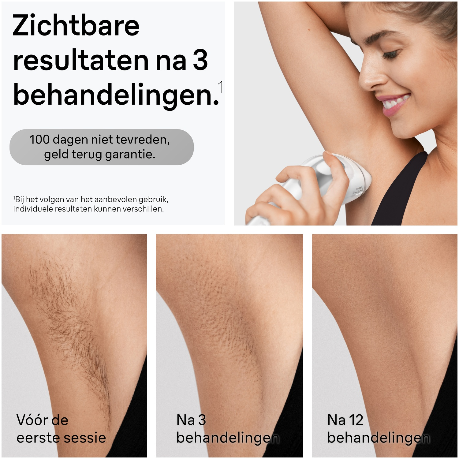 Hair removal device in use on an underarm and three stages of treatment results.