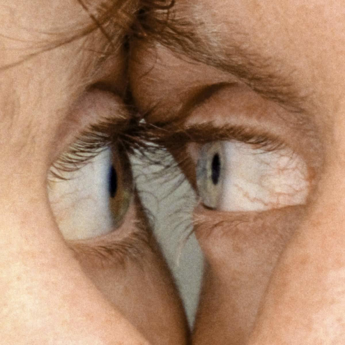 Nahaufnahme von zwei Augen, die in entgegengesetzte Richtungen blicken, mit fleischiger Trennung.