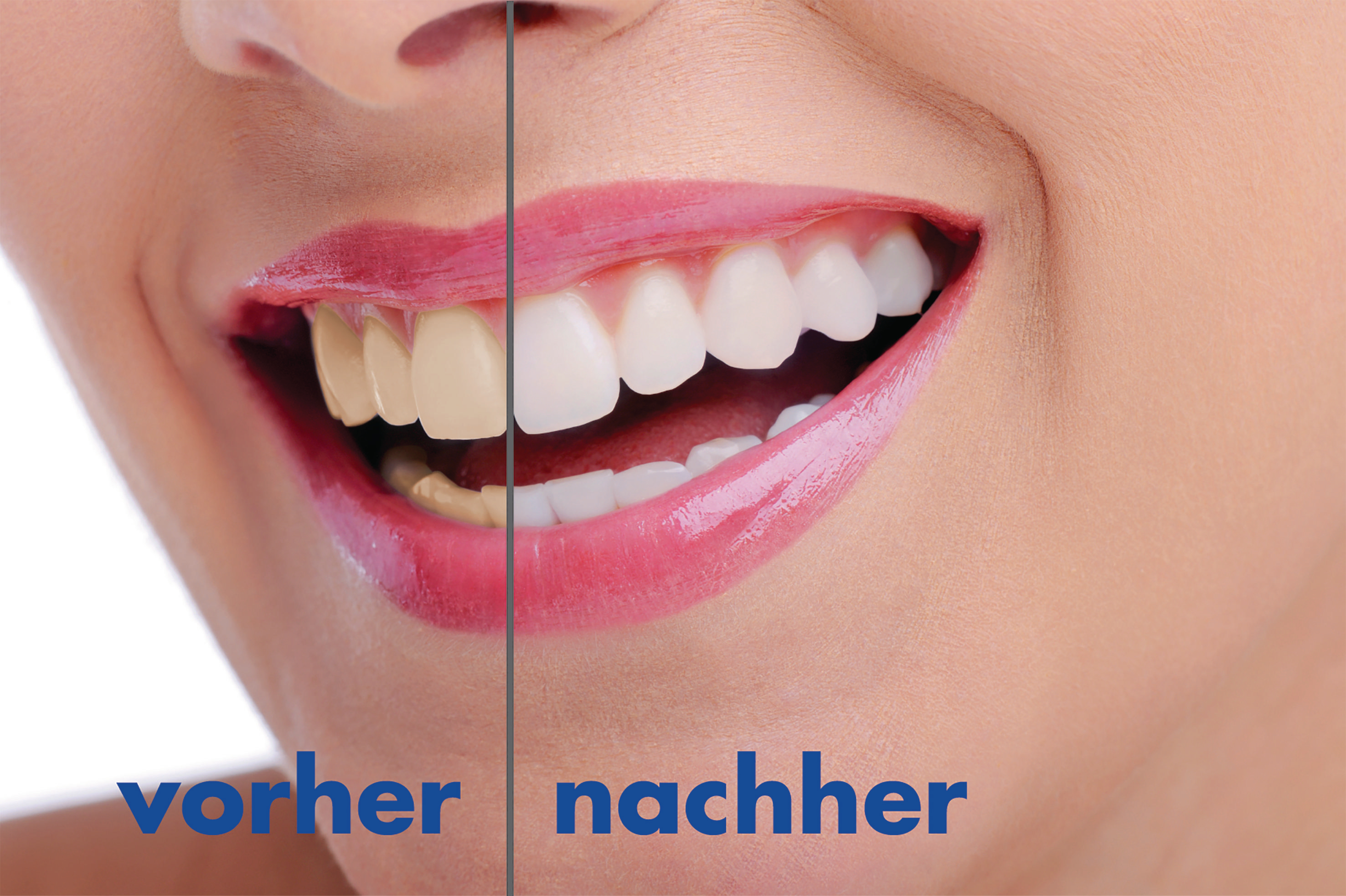 Das Lächeln einer Frau zeigt Ergebnisse des Zähnebleichens.