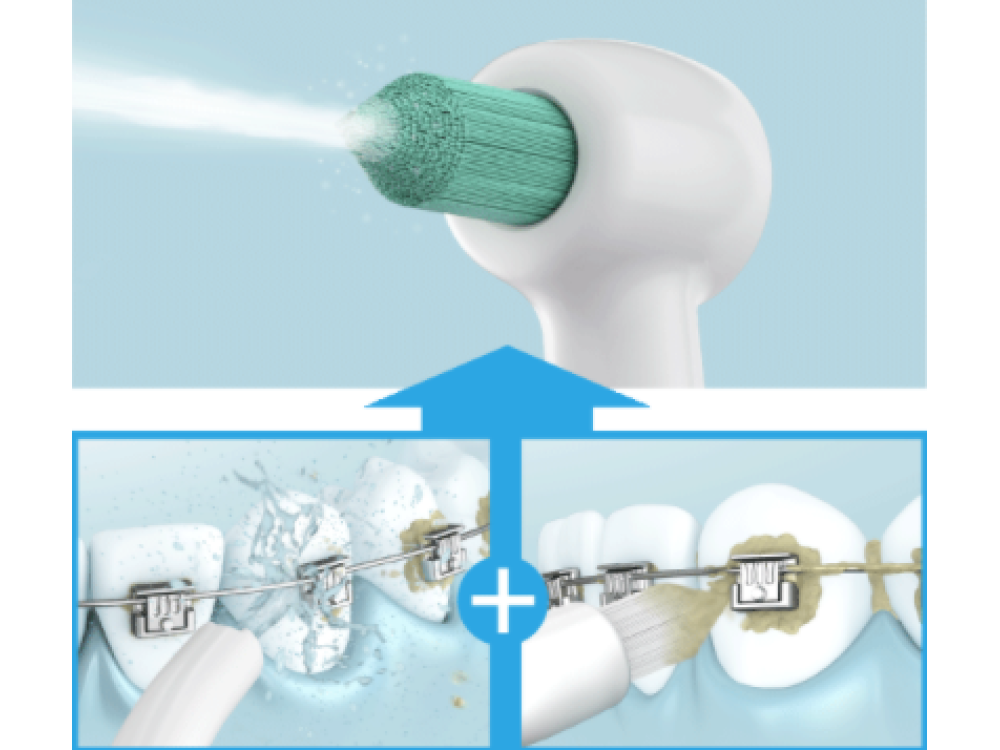 Diagrama que muestra el uso de un cepillo de dientes y un irrigador dental en dientes con brackets.