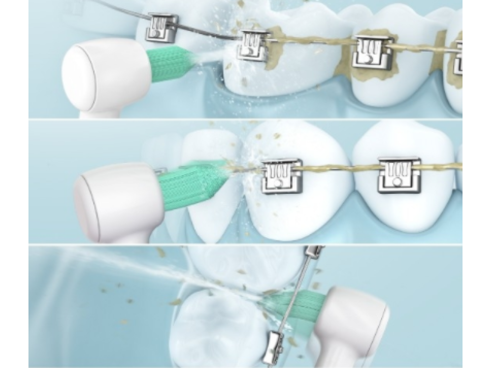 Ilustración animada de un cepillo de dientes que limpia los frenillos.