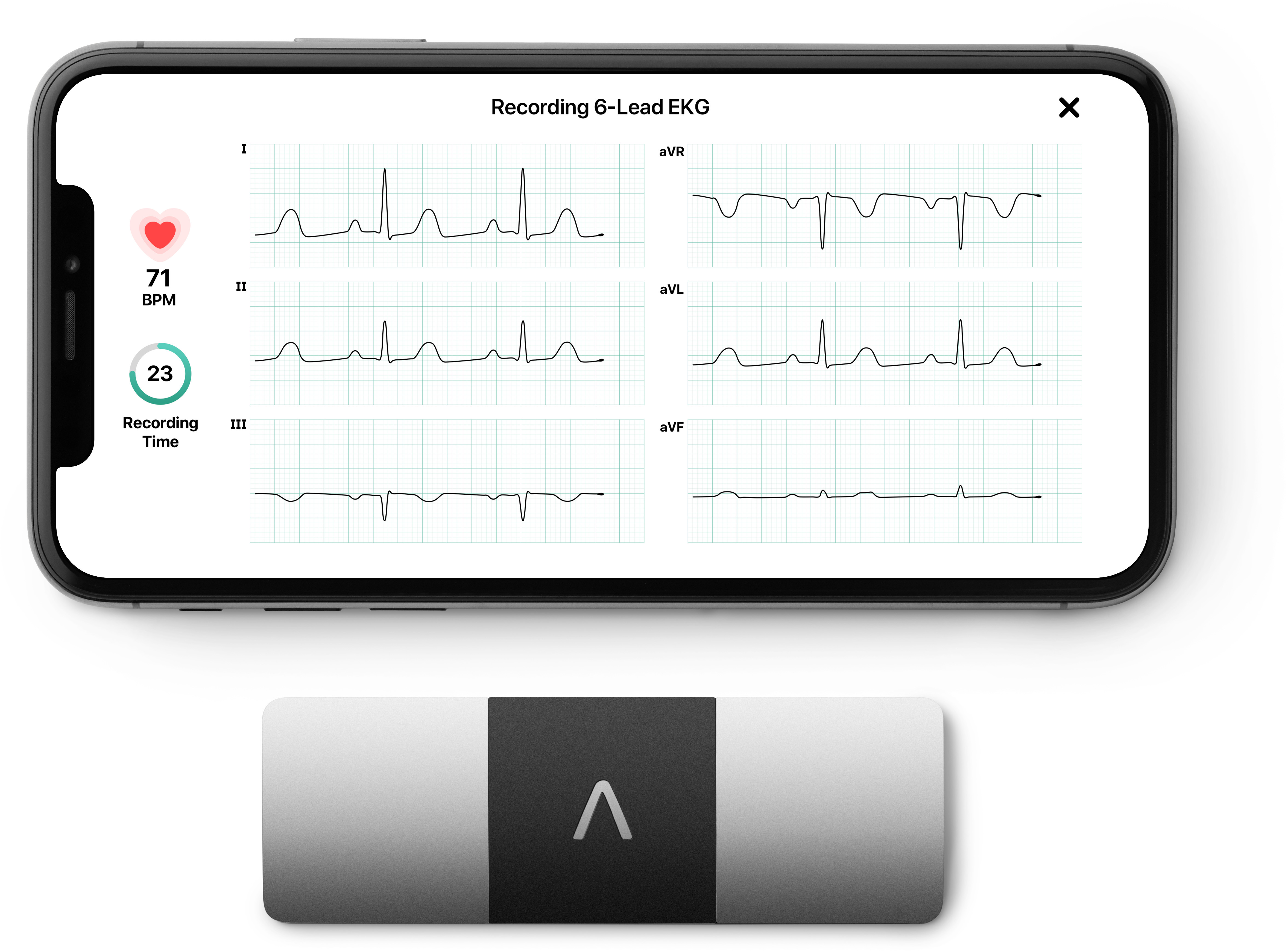 Okostelefon 6-csatornás EKG-t mutat. Kis eszköz alatta.