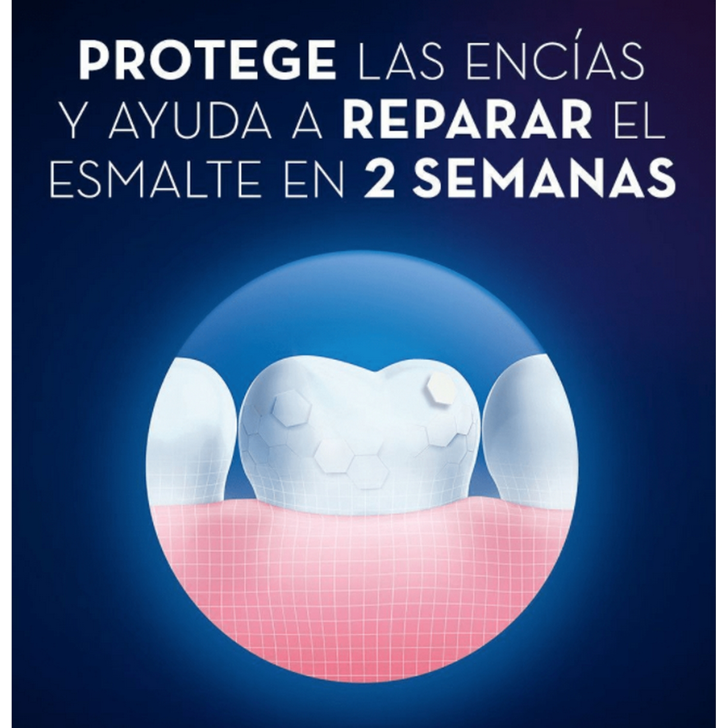 Diagrama de un diente con empaste blanco, rodeado de encías rosas.
