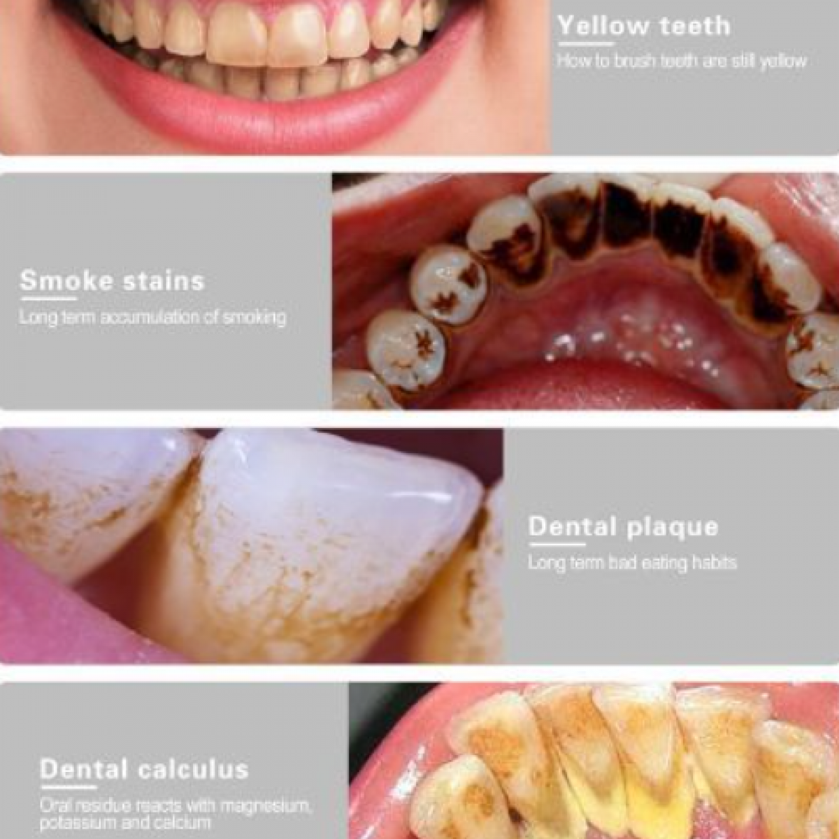 Zdjęcia zębów z problemami: żółte zęby, plamy po dymie, płytka nazębna i kamień nazębny.