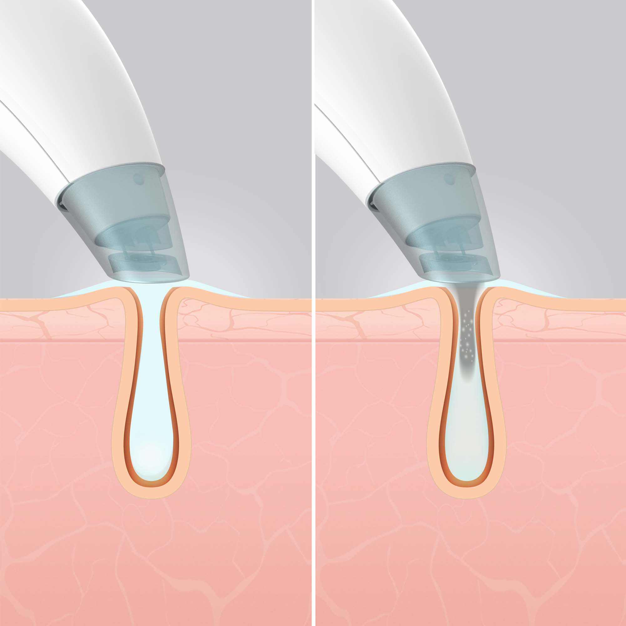 Dwa obrazy pokazujące oczyszczanie poru skóry, z narzędziem wyciągającym zanieczyszczenia.