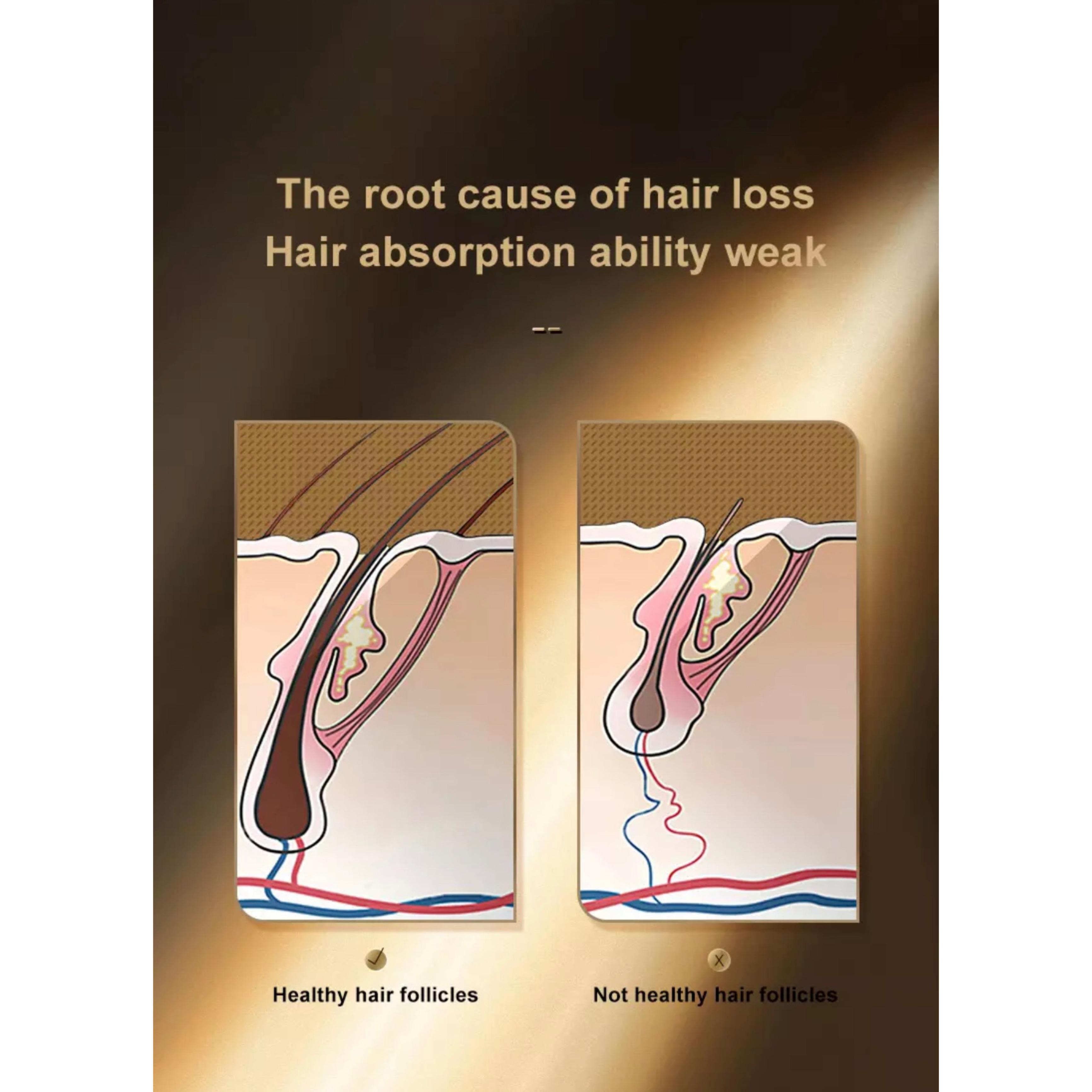 Schemat mieszków włosowych pokazujący zdrową i niezdrową absorpcję włosów.