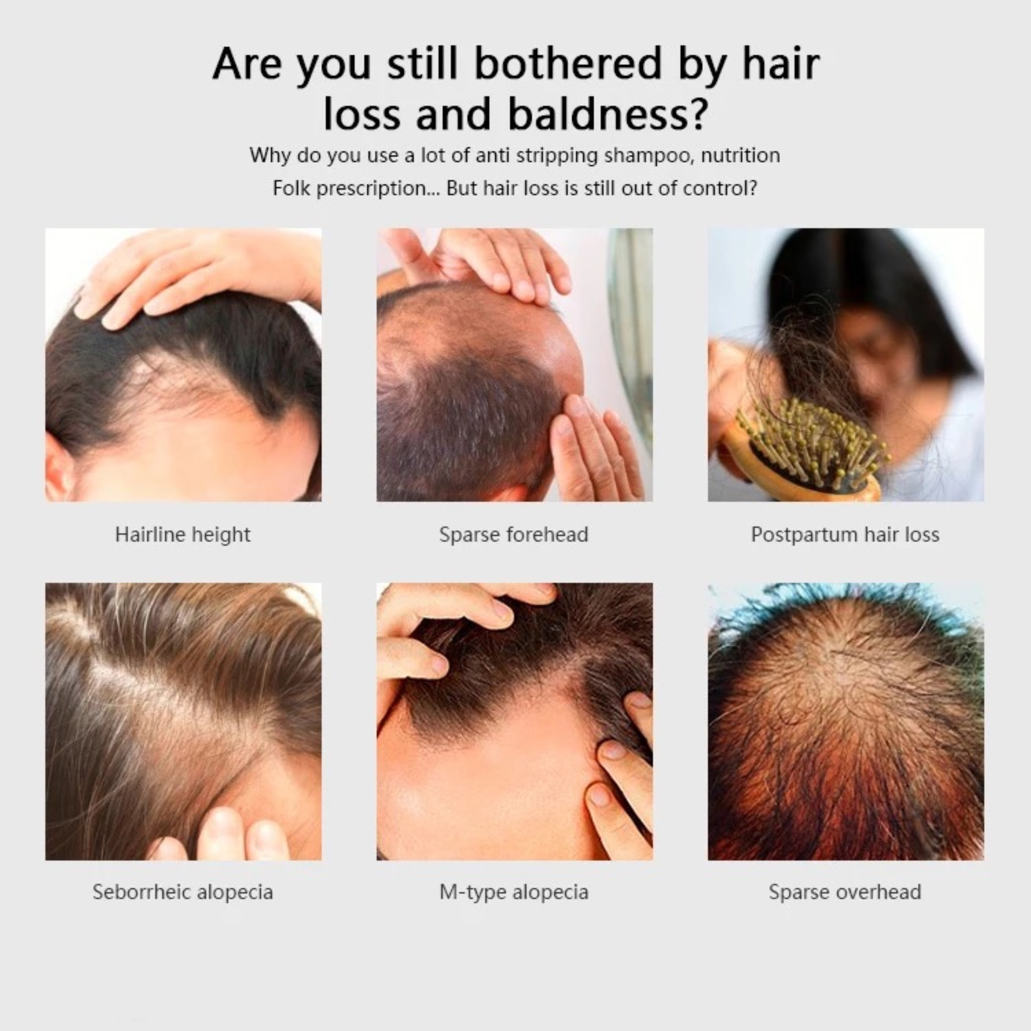 Kolaż zdjęć przedstawiających rodzaje wypadania włosów. Zawiera zdjęcia linii włosów, czoła itp.