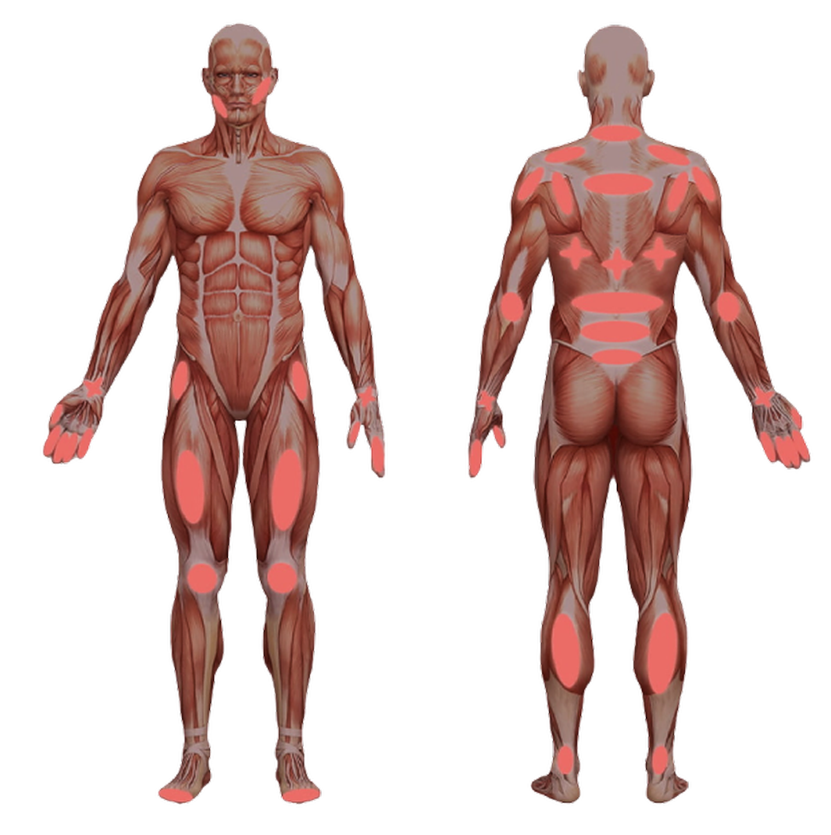 Eine anatomische Illustration des menschlichen Körpers mit rot hervorgehobenen Schmerzpunkten.