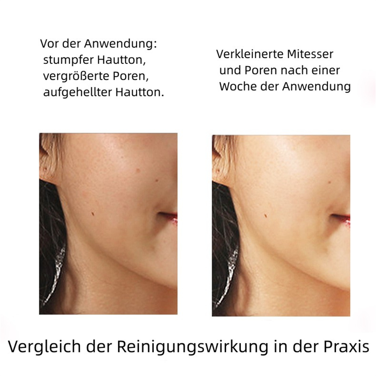 Vergleich der Haut vor und nach der Behandlung, zeigt eine Reduzierung der Poren und einen verbesserten Hautton.