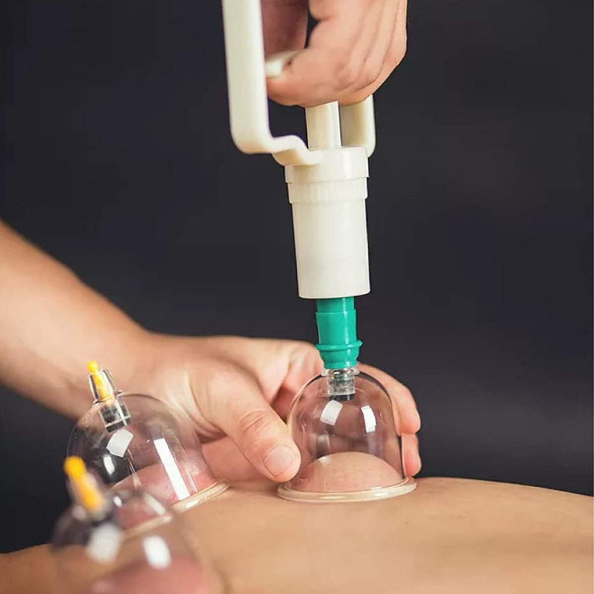 Person using a hand pump to create suction in cupping therapy. Multiple cups are applied to the back.
