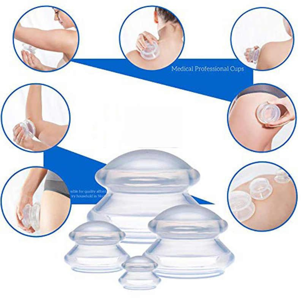 Coppe professionali mediche, un set di strumenti per la coppettazione, utilizzati su diverse parti del corpo.