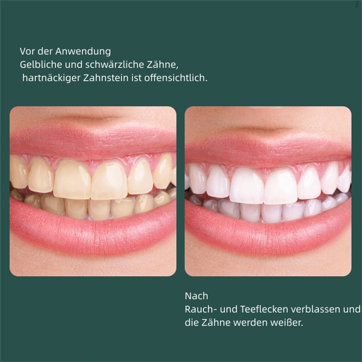 Imagen comparativa de dientes antes y después del blanqueamiento, mejora visible.