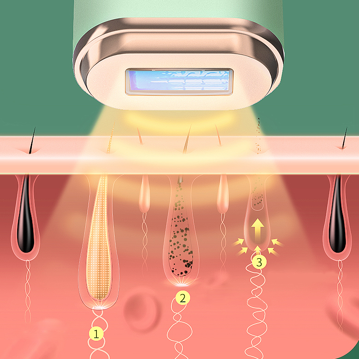 Diagramm der Haarfollikelentfernung mit einem Laser. Zeigt den Laser, die Haut und die Haarfollikelstadien.