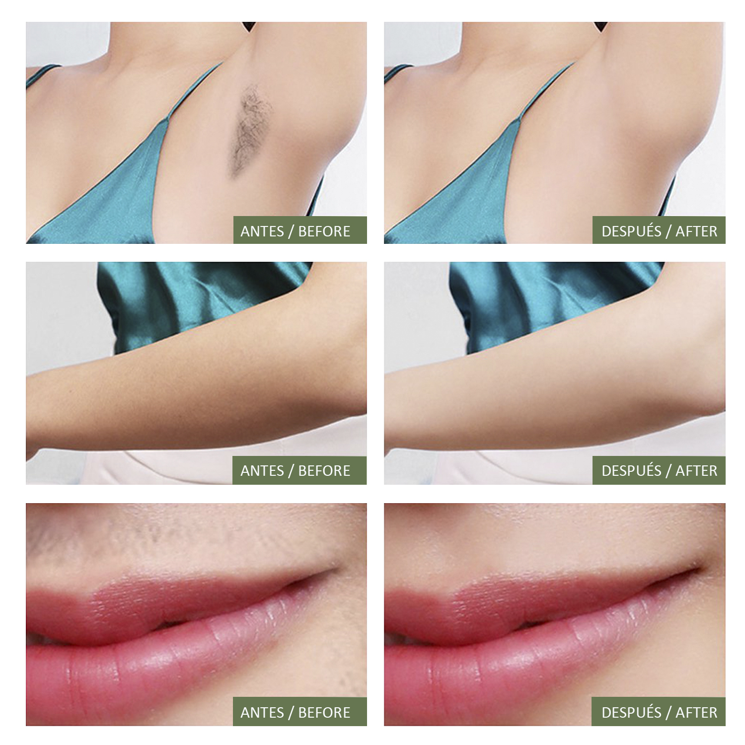 Vorher-Nachher-Bilder von Haarentfernung an Achseln, Armen und Lippen.