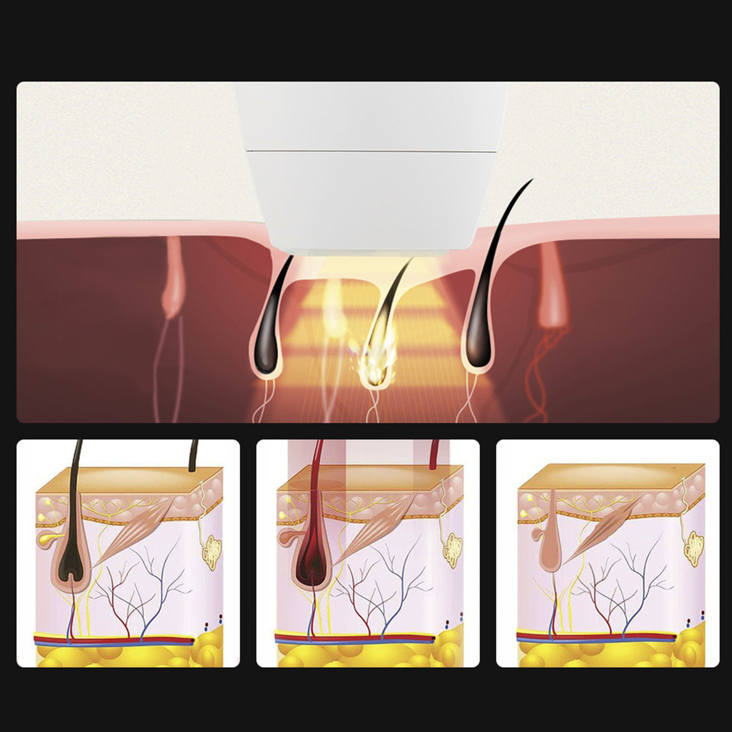 Illustration zur Haarentfernung mit Laser, zeigt den Vorgang im Hautquerschnitt.