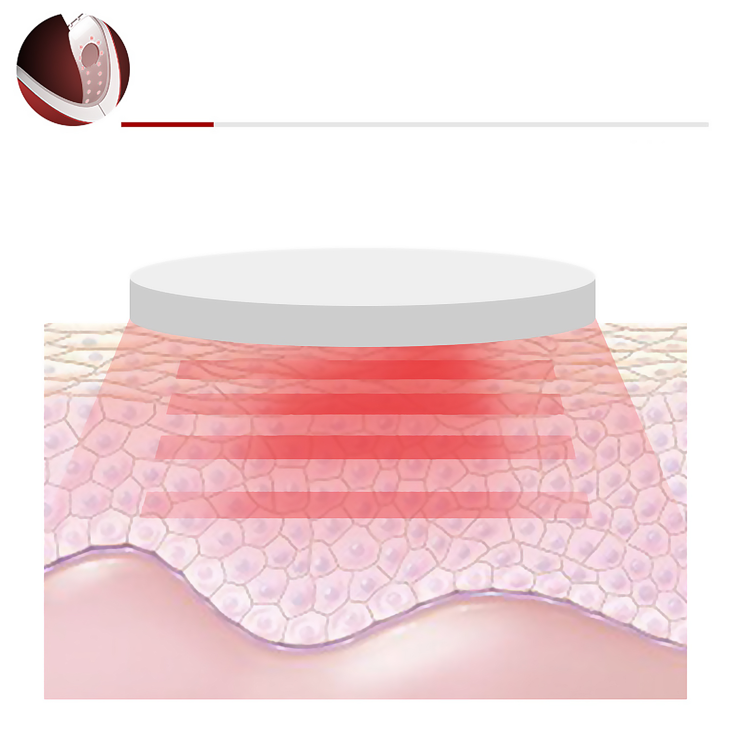 Hautschichten mit Lasermassage-Diagramm. Rotes Licht auf die Haut fokussiert.
