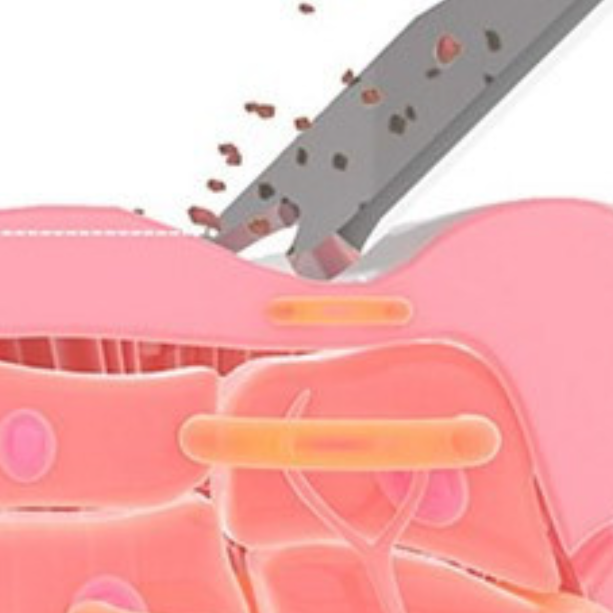 Anatomische Illustration der Hautschichten mit einem Werkzeug, das ein Hautstück entfernt.