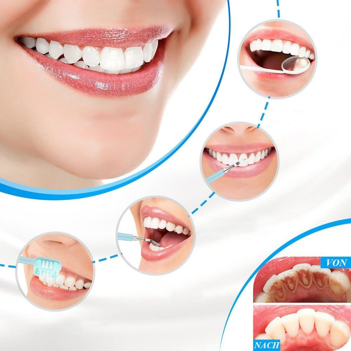 5 Zahnsteinentferner Zahnreinigungsmodi Weiß ELKUAIE