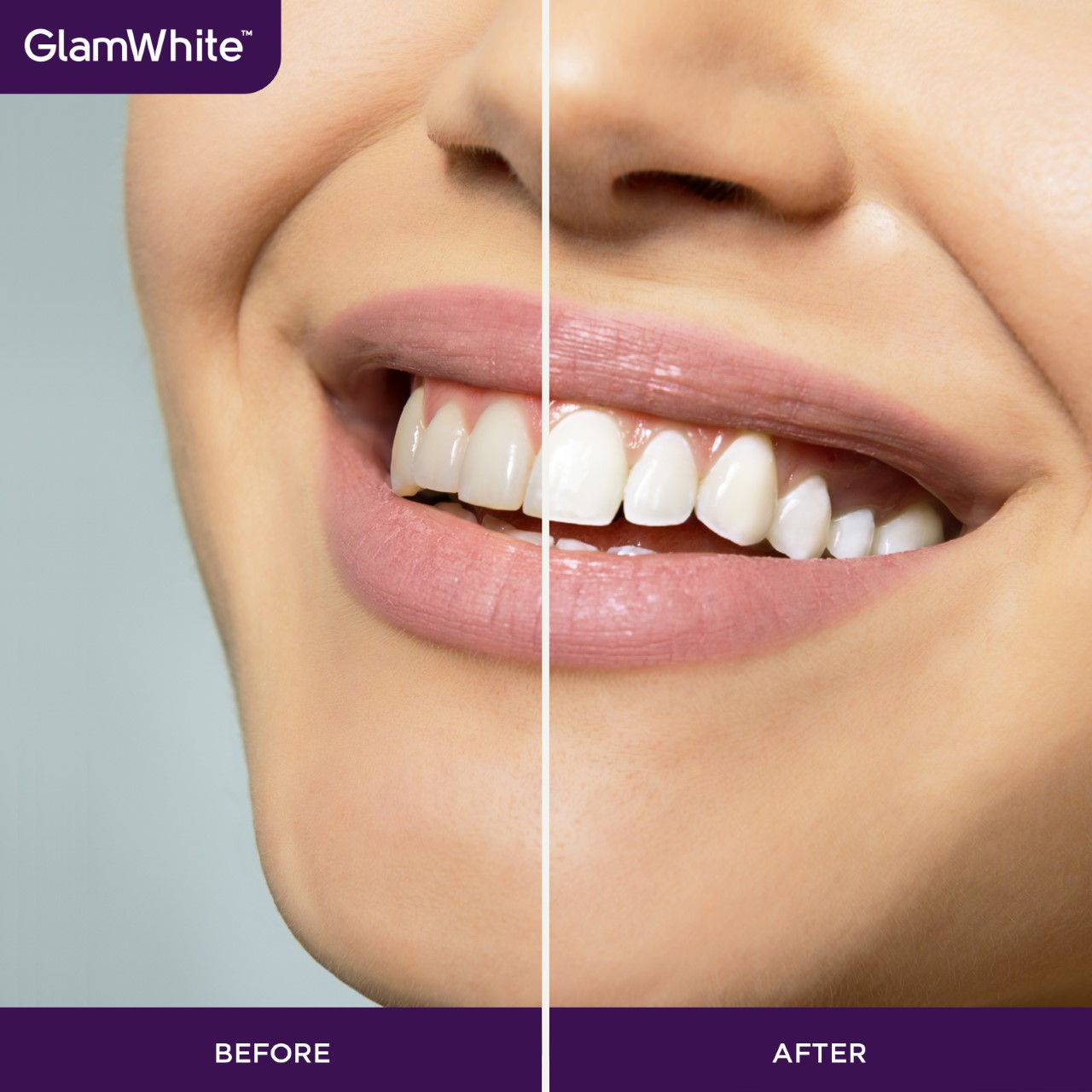 Imagen del antes y el después de los dientes de una mujer sonriente, mostrando resultados de blanqueamiento.