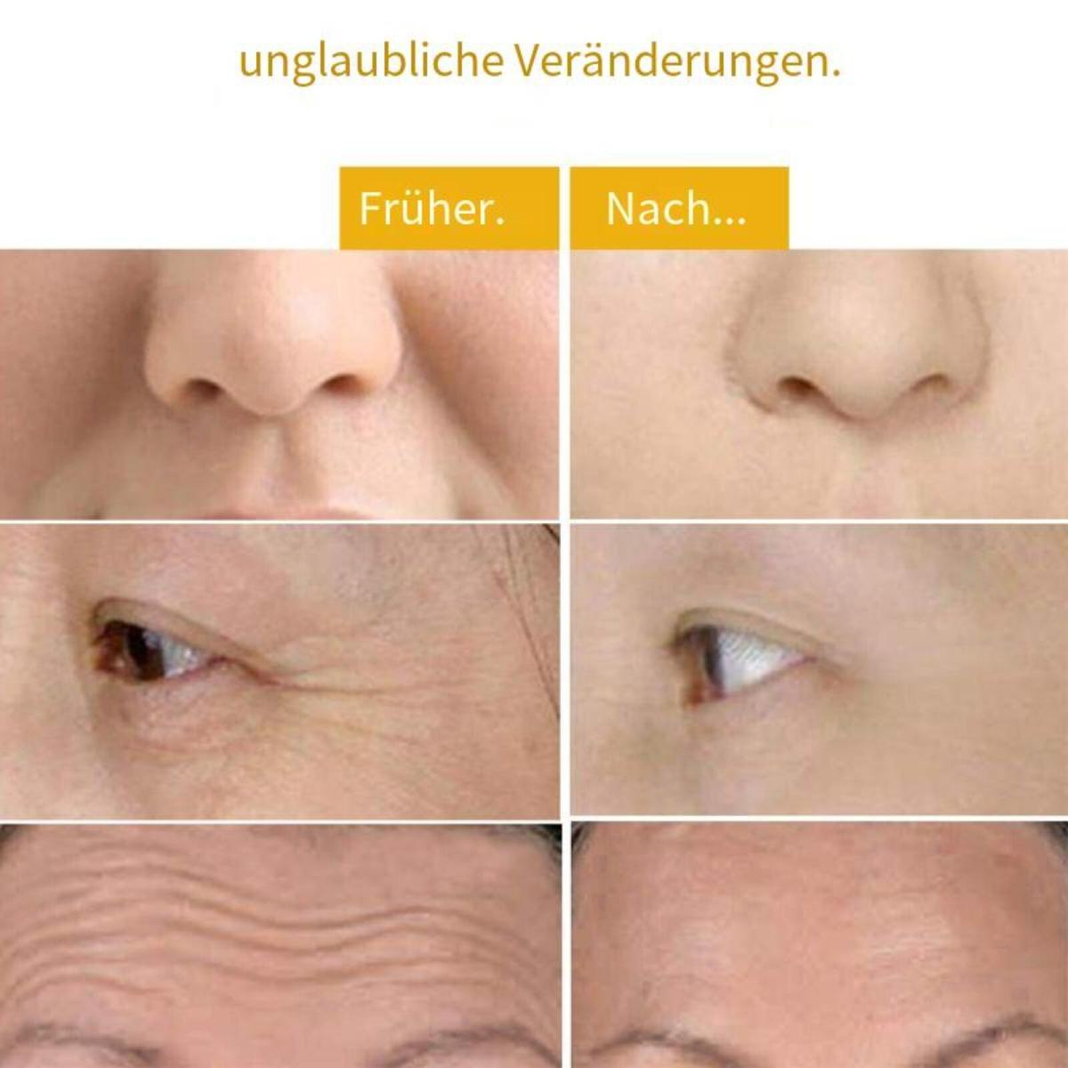 Vorher-Nachher-Bilder von Gesichtshaut. Zeigt Falten.