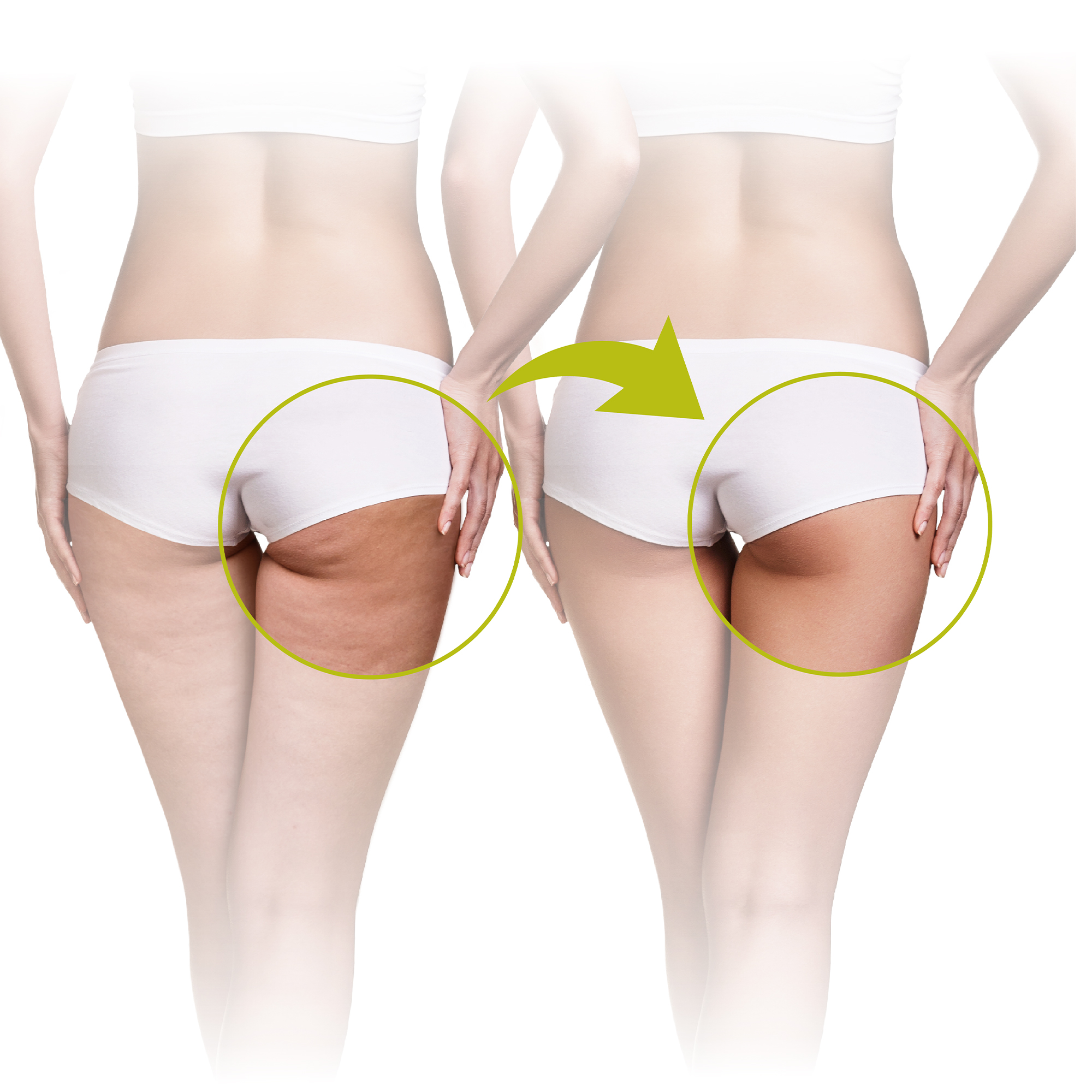 Comparison of a woman's buttocks before and after treatment, with green arrow.