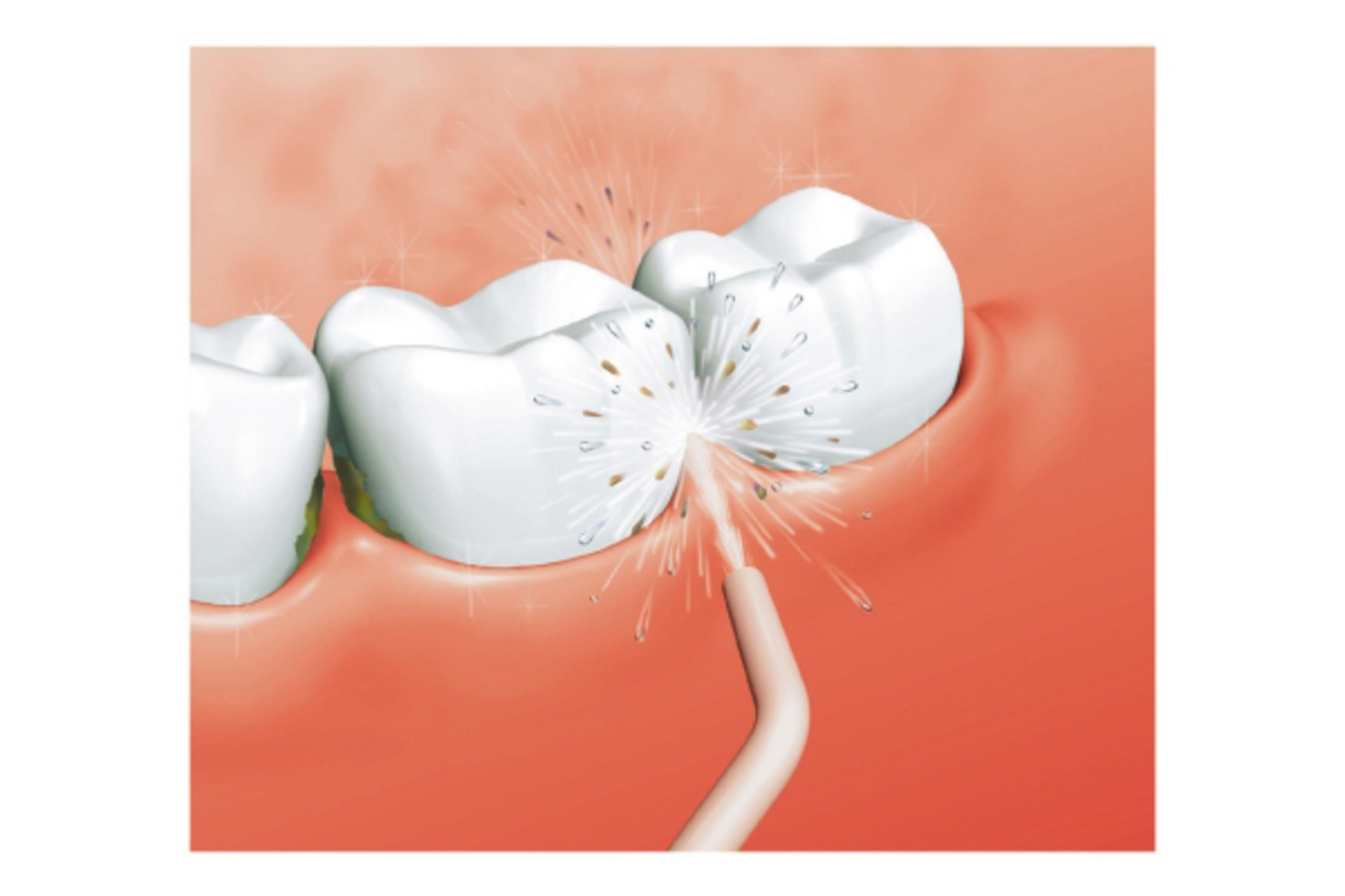 Illustration dentaire de dents nettoyées avec un jet d'eau. Les dents sont blanches et le fond rouge.