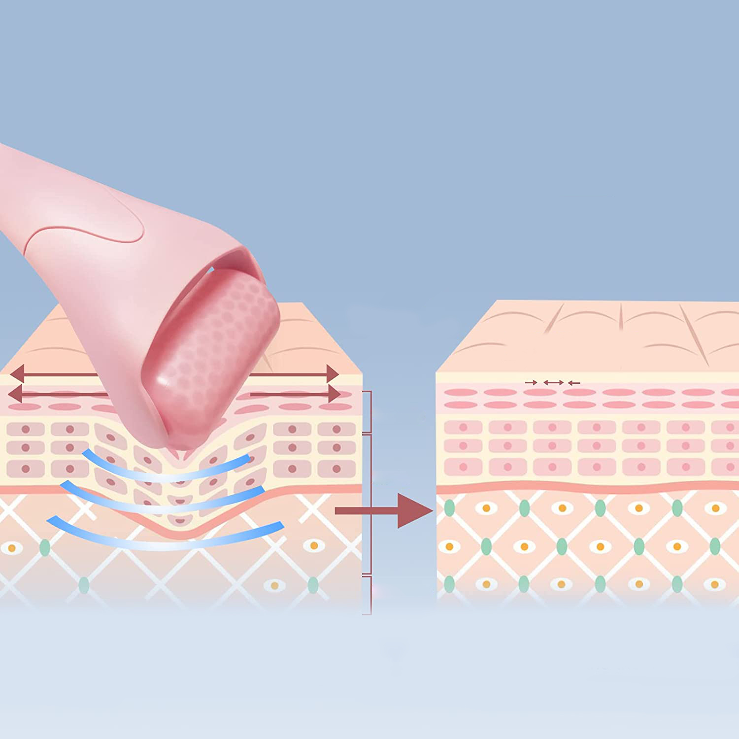 Rosa Werkzeug, Hautdiagramm mit Schichten, Pfeilen.  Zeigt den Prozess der Hautbehandlung.