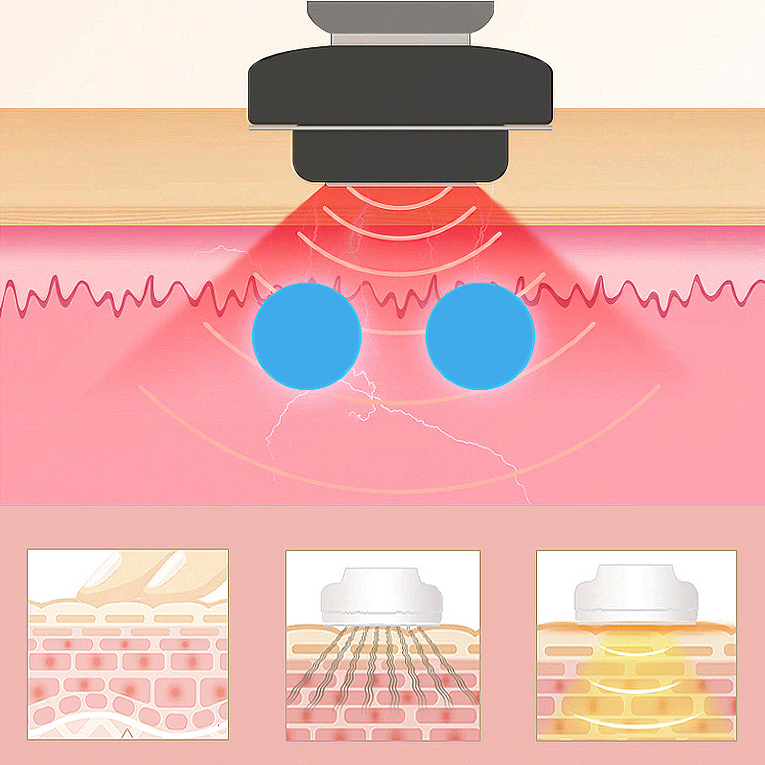 Diagramm der Haut mit roter Laserbehandlung. Blaue Kreise stellen Energiepunkte dar, Hautquerschnitte.