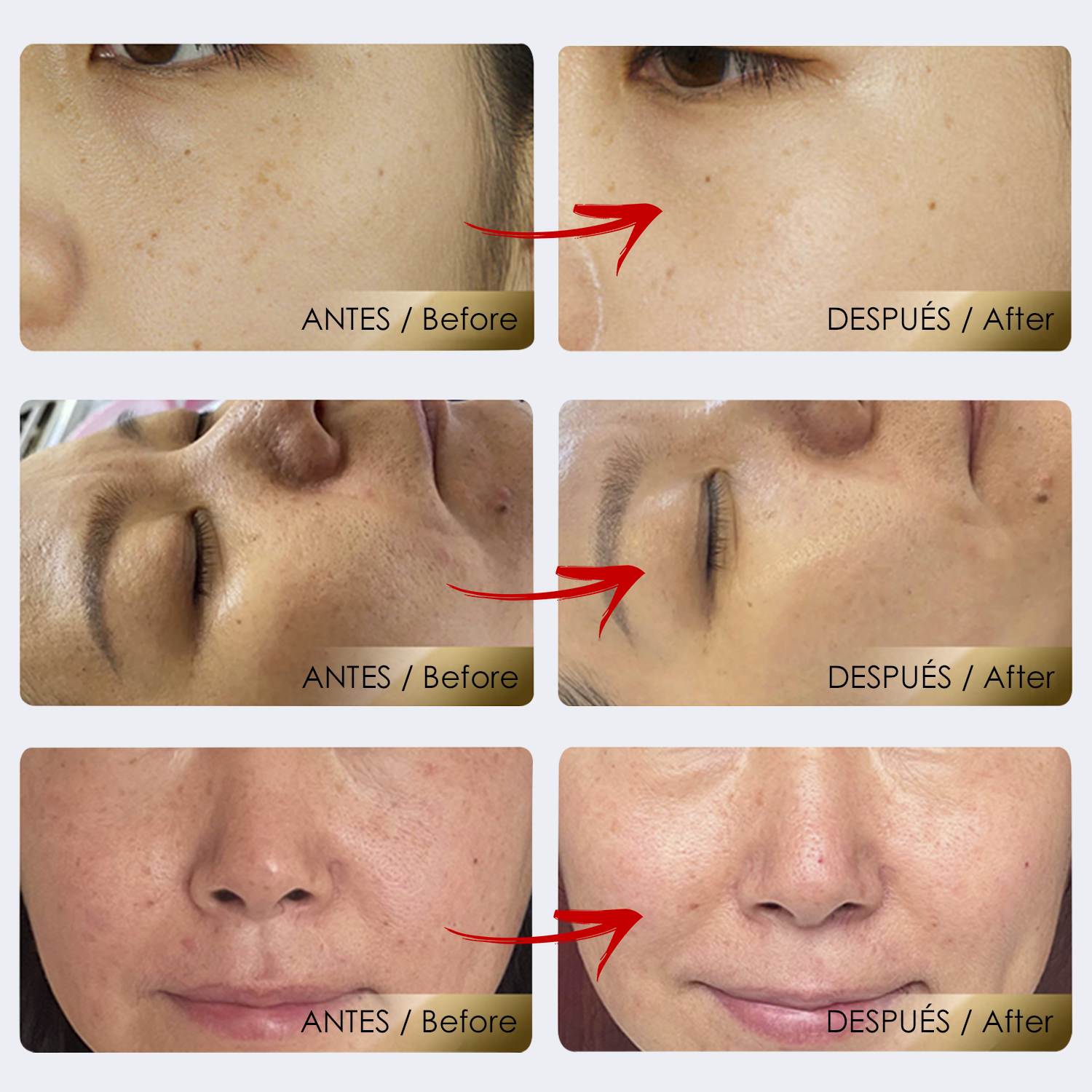 Imágenes del antes y el después de un rostro, mostrando los resultados del tratamiento de la piel en poros y arrugas.