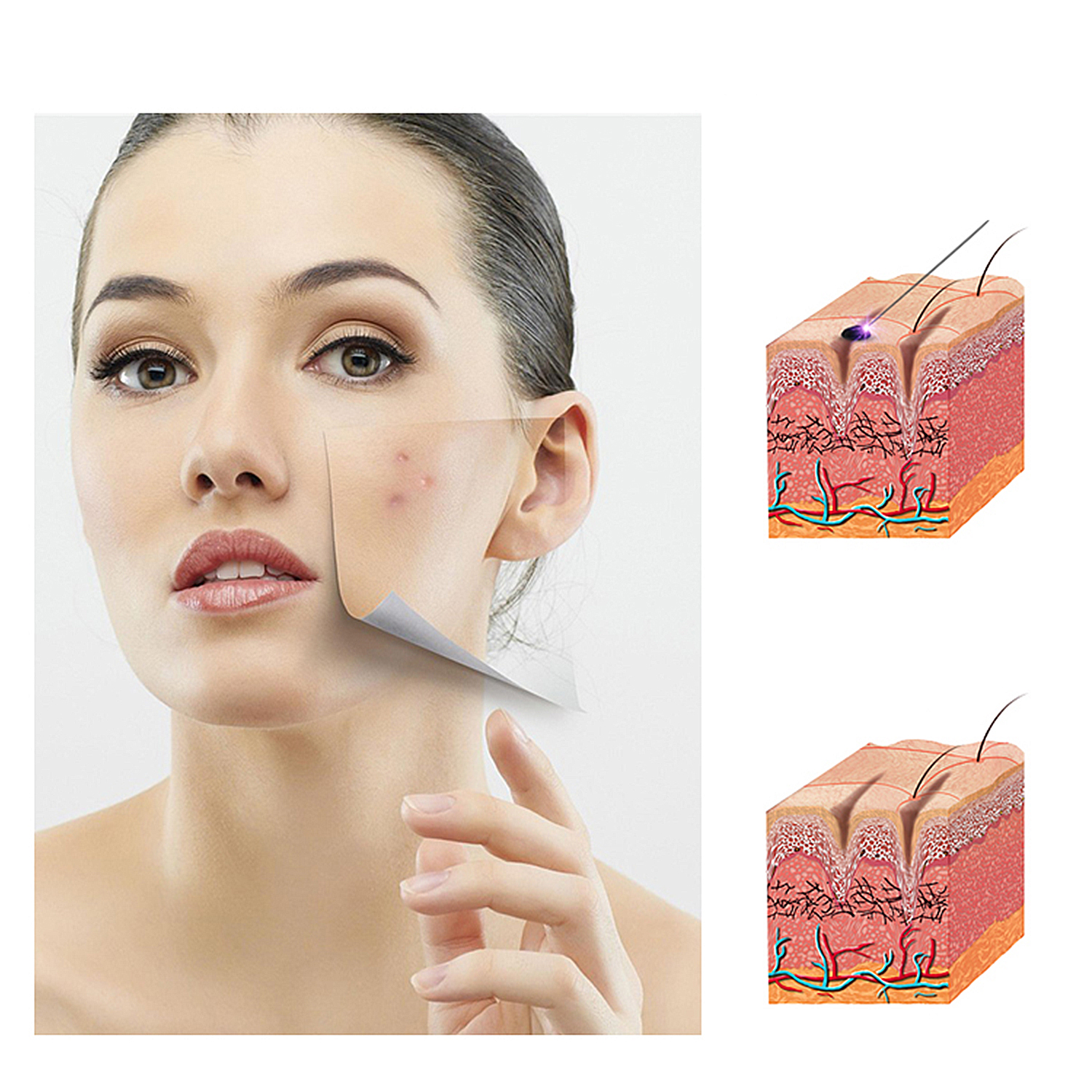 Mujer con piel despegada mostrando capas de piel, acné y corte transversal de piel.