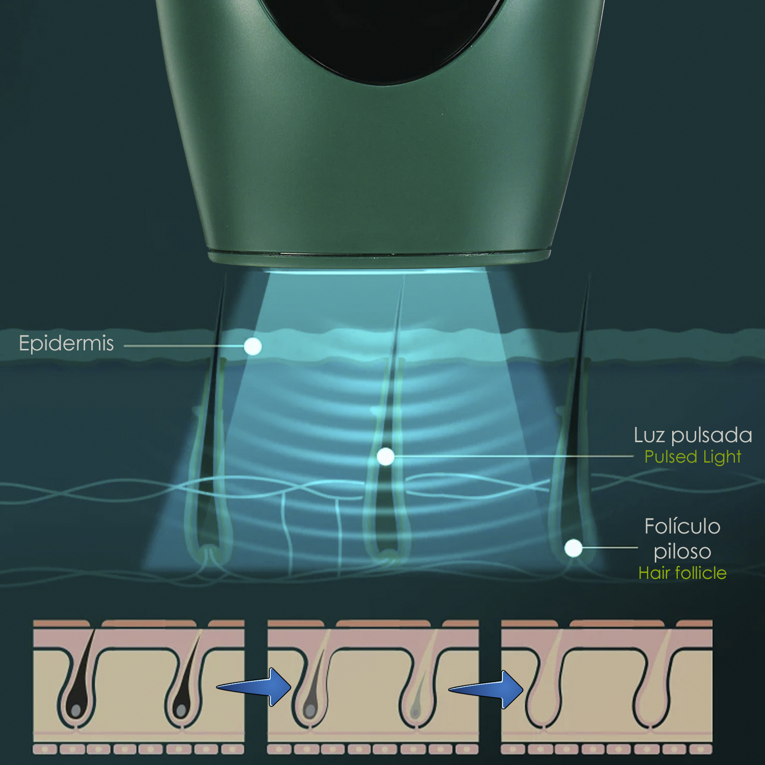 Diagramm der Laser-Haarentfernung. Ein Gerät strahlt Licht aus, das auf Haarfollikel abzielt, und zeigt die Reduzierung.