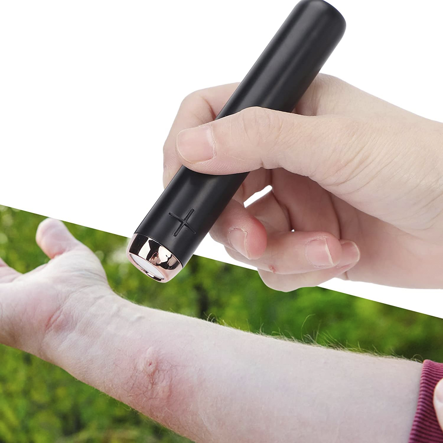 Una mano sostiene un dispositivo negro para tratar una zona roja e inflamada de la piel en un brazo.