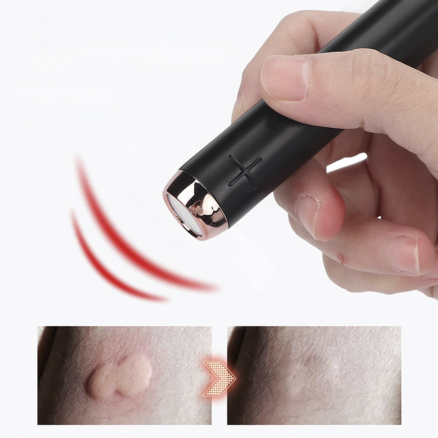Un dispositivo negro en forma de bolígrafo, con una línea curva roja e imágenes de la piel antes y después.