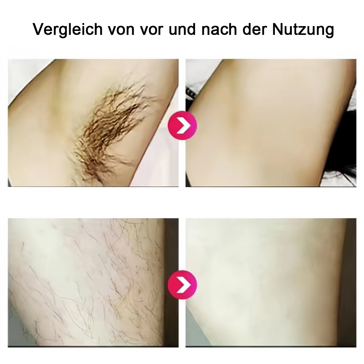 Bildvergleich vor und nach der Haarentfernung an Achseln und Beinen, zeigt glatte Haut danach.