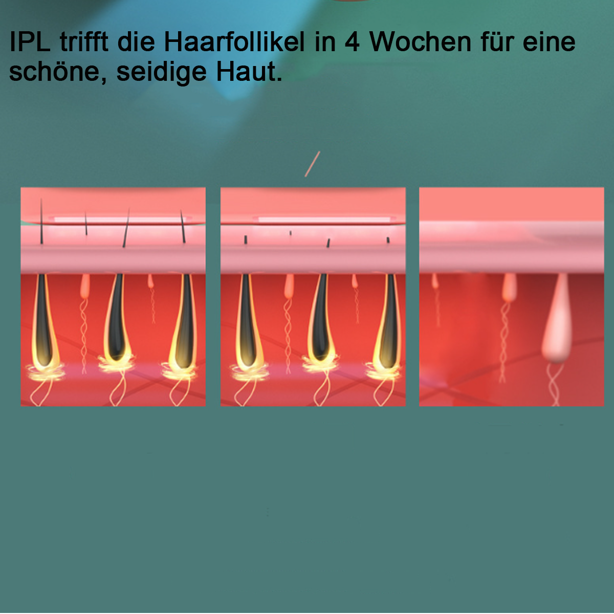Drei Bilder, die die Wirkung von IPL auf Haarfollikel zeigen, von der anfänglichen bis zur vollständigen Entfernung.