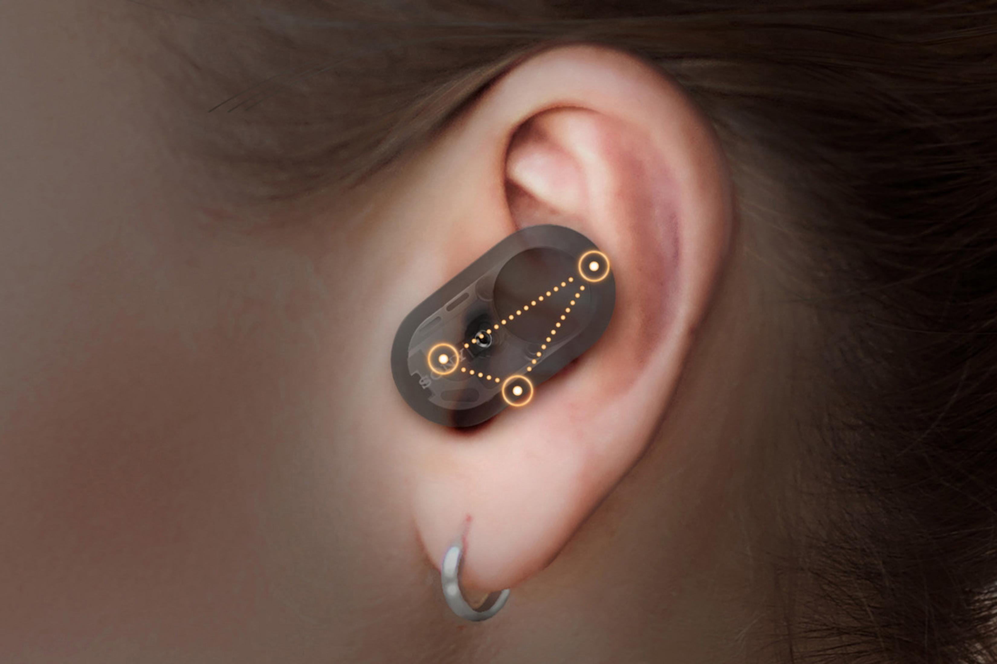 Ohr mit transparentem Ohrhörer. Vier Punkte zeigen, wo der Ohrhörer sitzt.