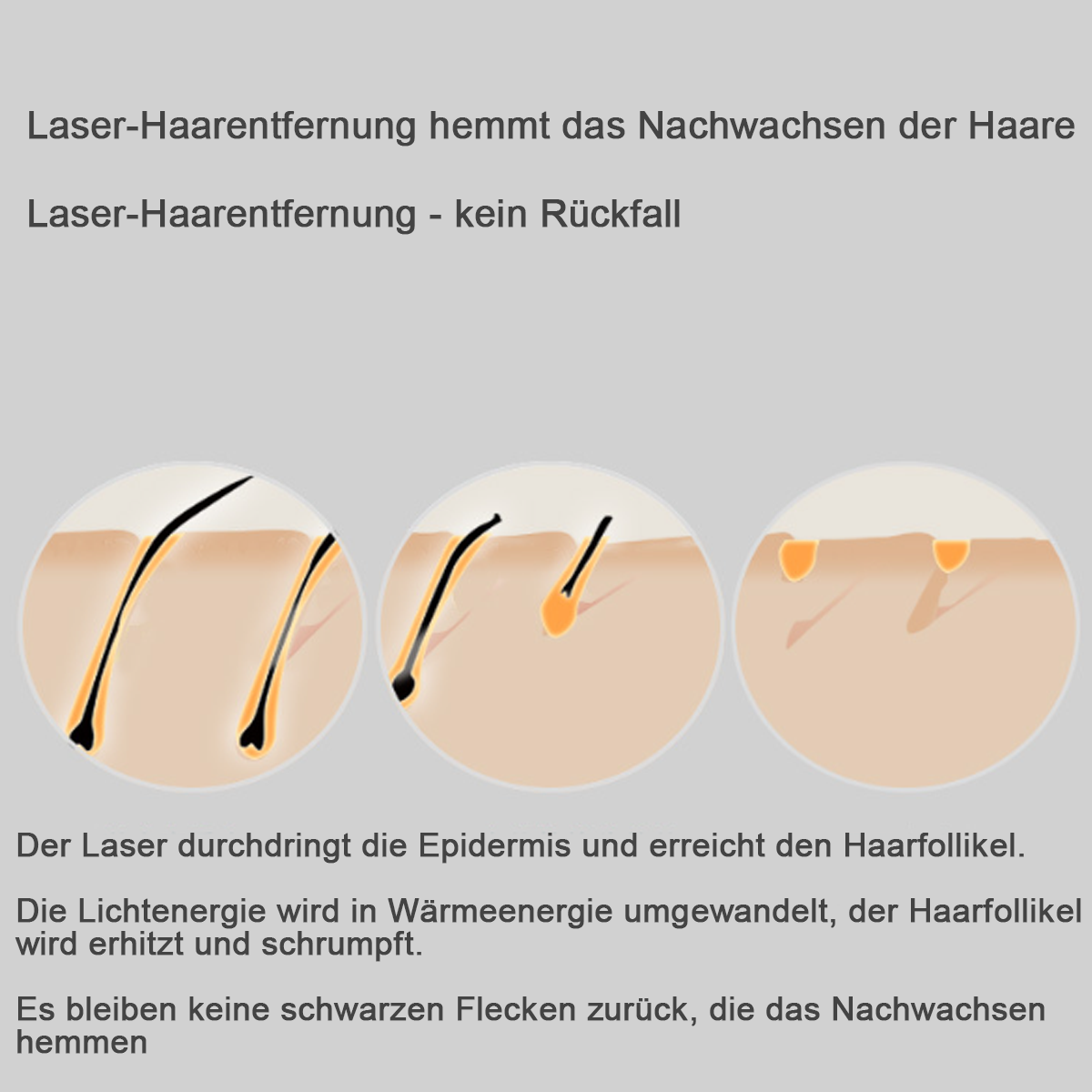 Diagramm zur Laser-Haarentfernung, das Veränderungen der Haarfollikel zeigt.