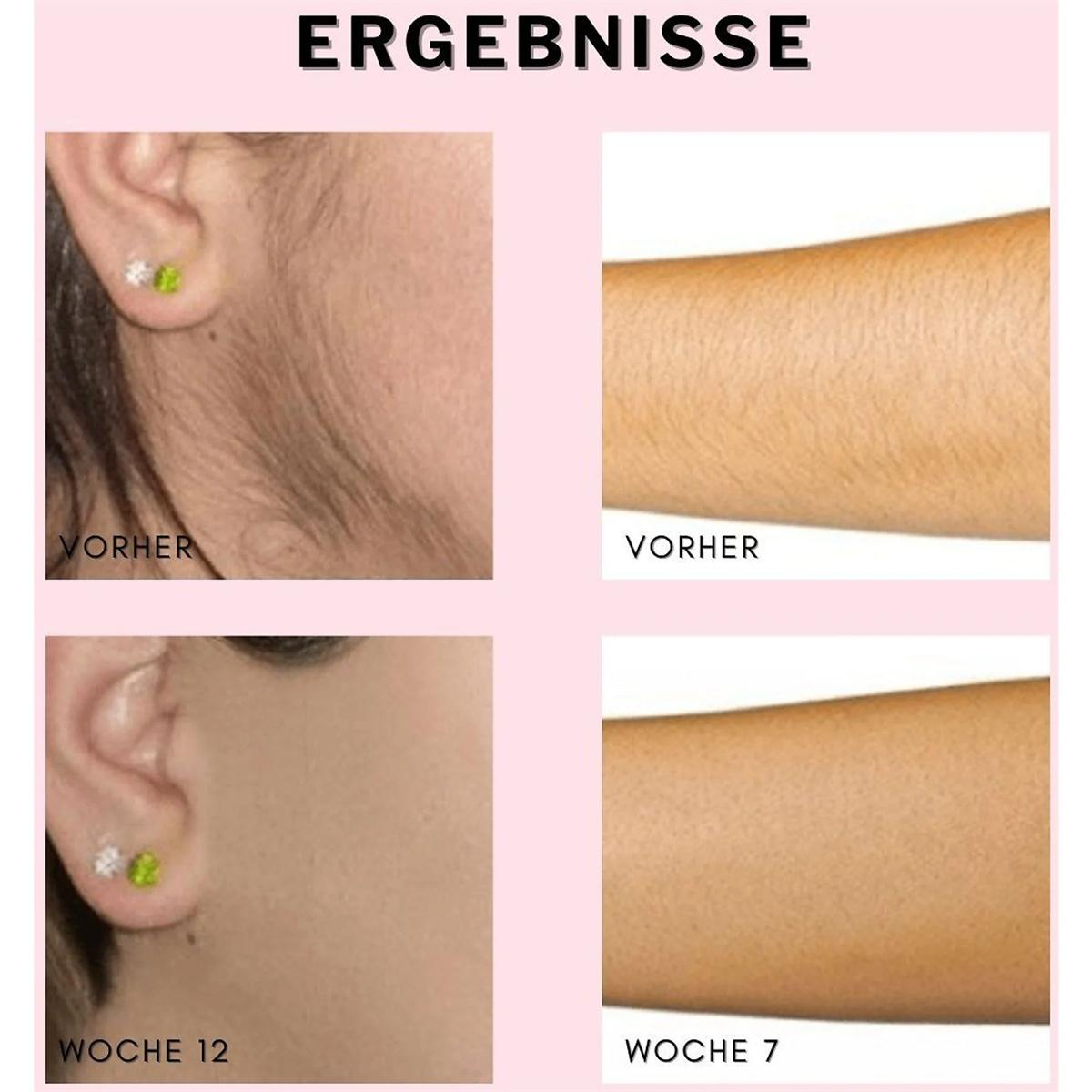 Bilder zeigen Ergebnisse der Haarentfernung. Vorher-Nachher von Ohr- und Armhaaren.