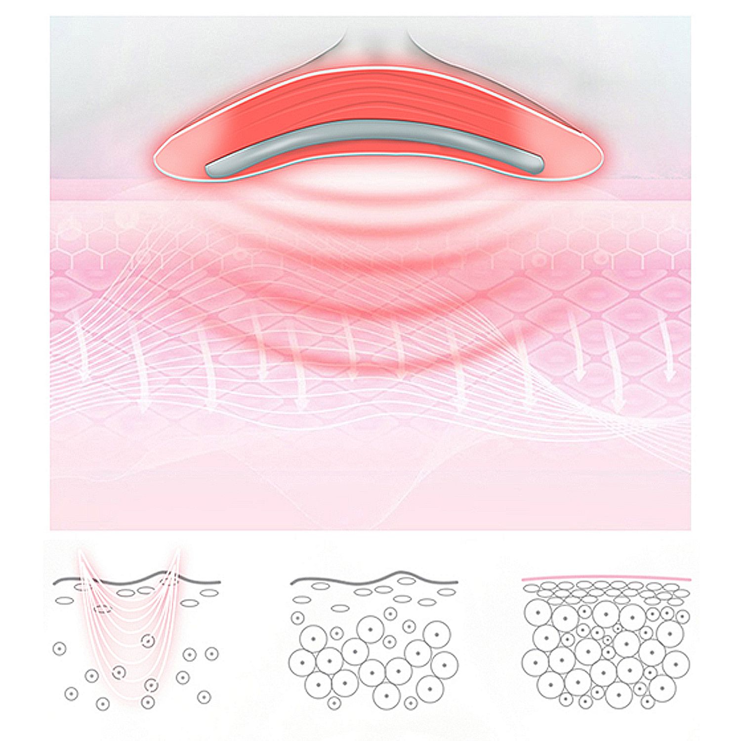 Una ilustración de capas de piel con un dispositivo emitiendo ondas rojas. Tres diagramas muestran detalles de la piel.