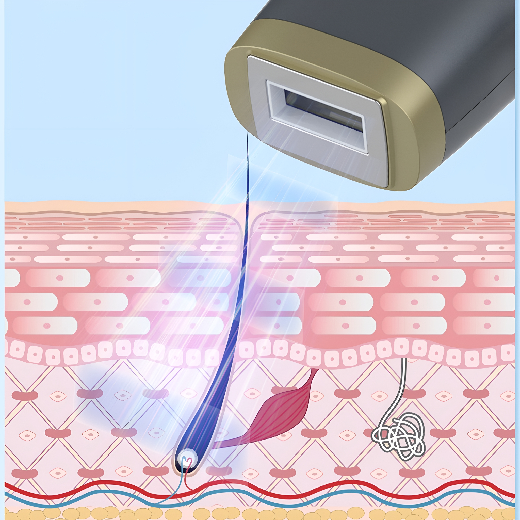 Diagramm der Laser-Haarentfernung. Der Laser zielt auf den Haarfollikel und zerstört ihn, ohne die Haut zu schädigen.