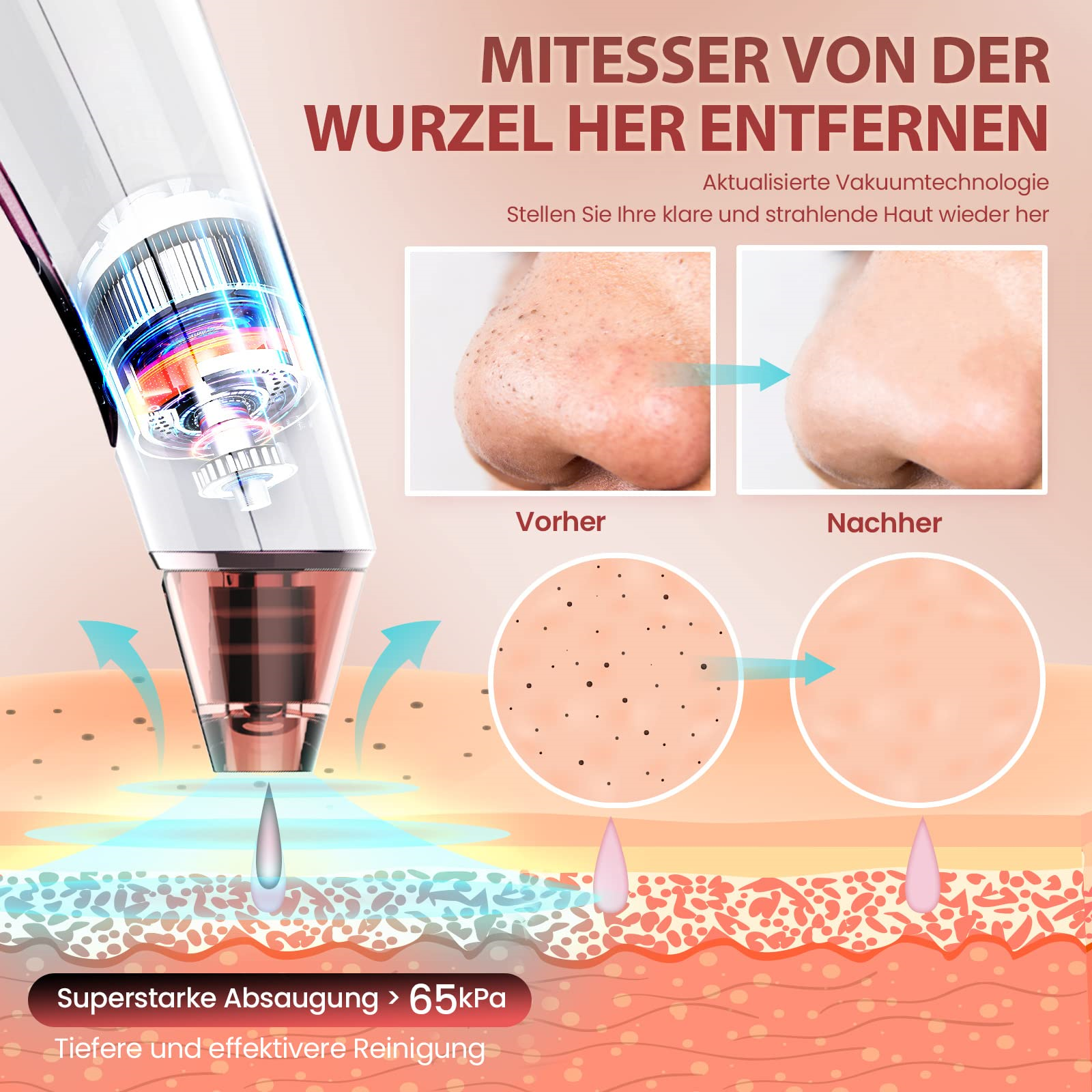 Ein Gerät zur Entfernung von Mitessern. Bilder zeigen Vorher-Nachher, Querschnitts-Hautdiagramm.