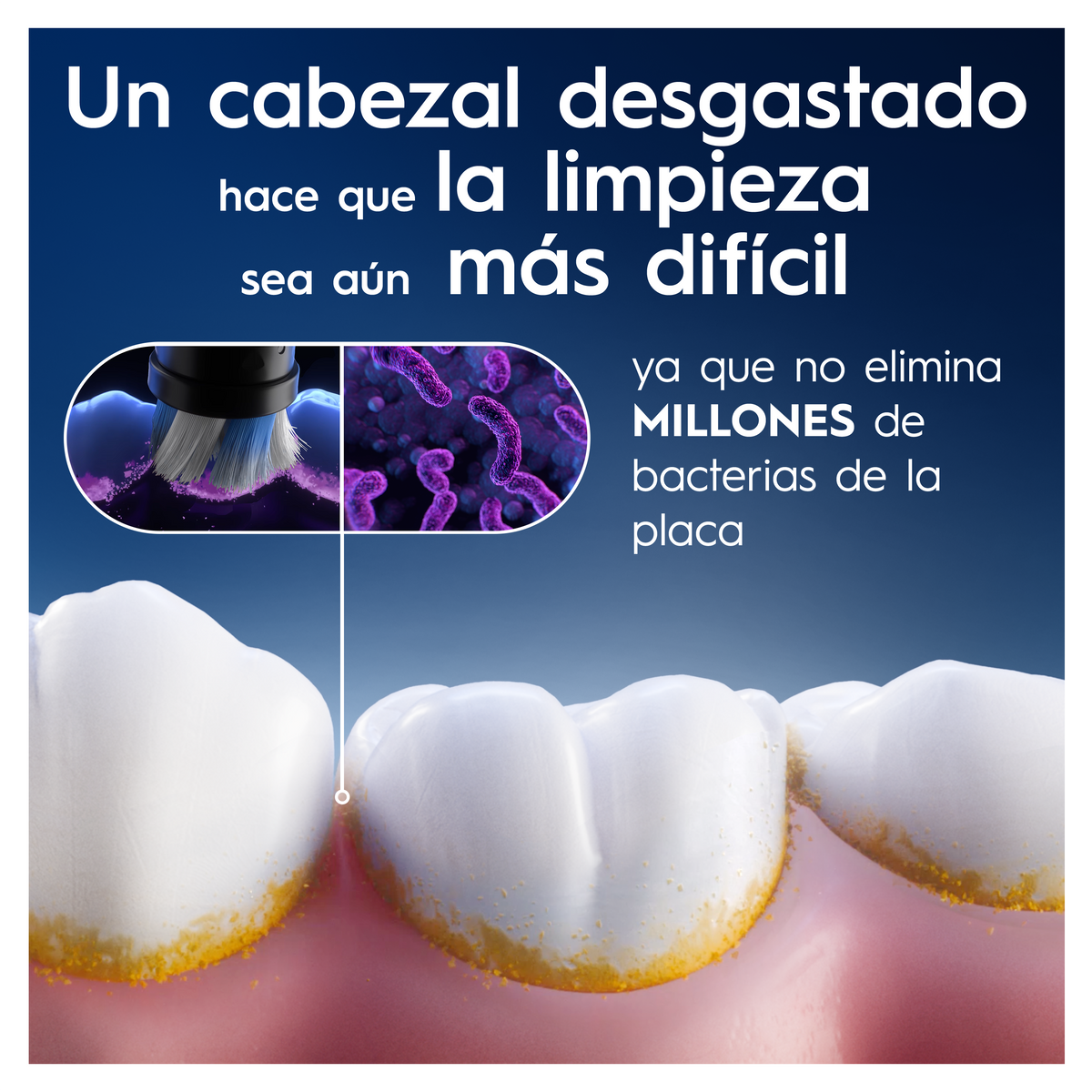 Primo piano dei denti con placca e uno spazzolino da denti.