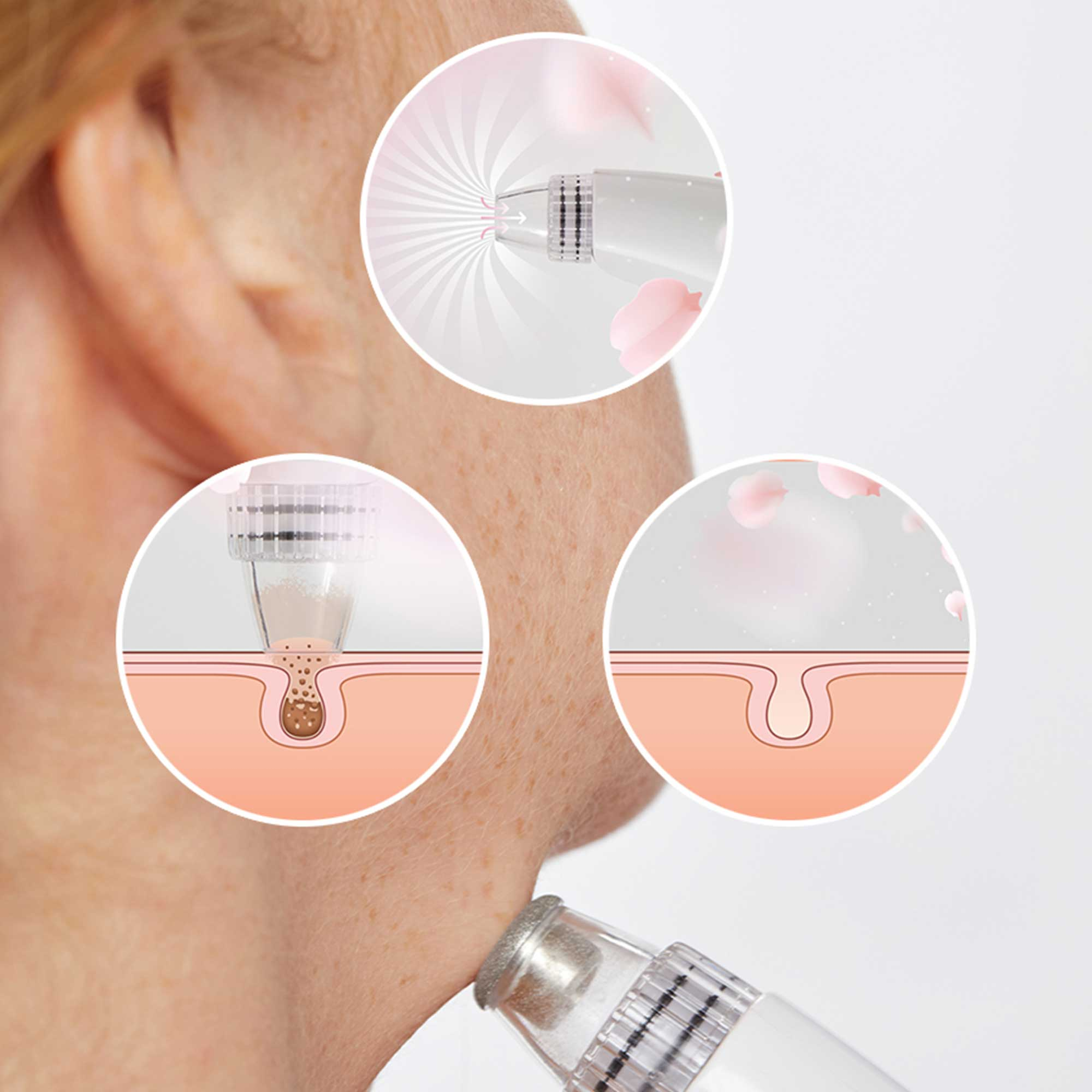 Diagram of skin care with blackhead removal. A tool extracts sebum, leaving a clean pore.