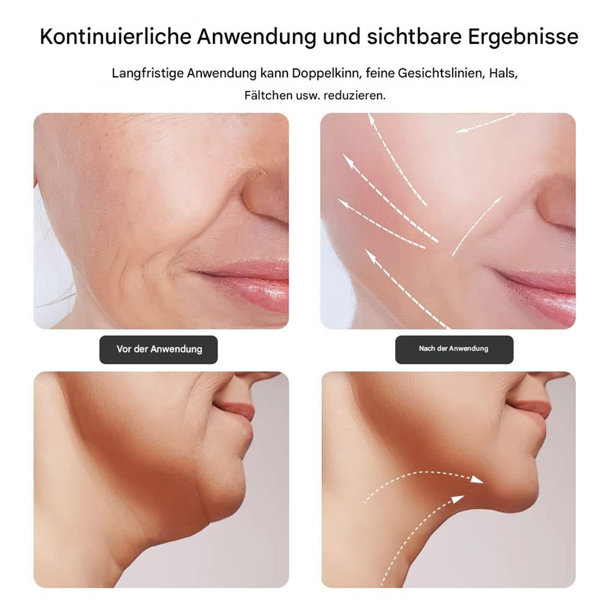 Bilder, die Vorher-Nachher-Effekte eines Hautpflegeprodukts zeigen, mit Fokus auf die Reduzierung des Doppelkinns.