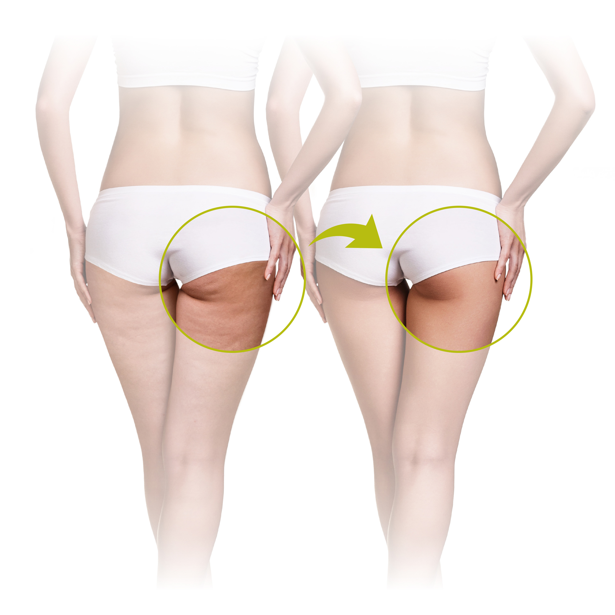 Vorher-Nachher-Bild vom Gesäß einer Frau, das eine Reduzierung von Cellulite zeigt.