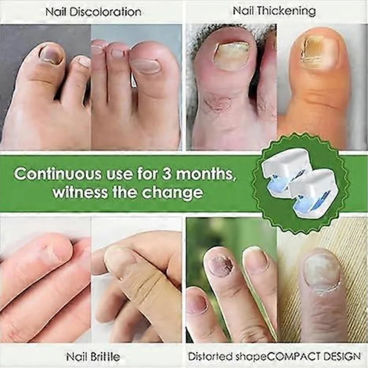 Bilder von Zehennägeln, die Verfärbungen, Verdickungen und andere Nagelzustände zeigen.