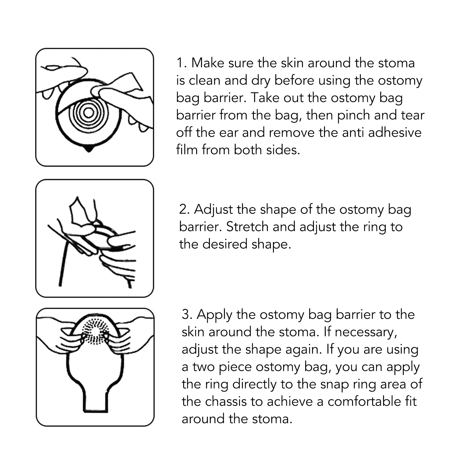 Anweisungen zur Verwendung eines Ostomiebeutels: Haut reinigen, Beutel anpassen und um das Stoma anbringen.