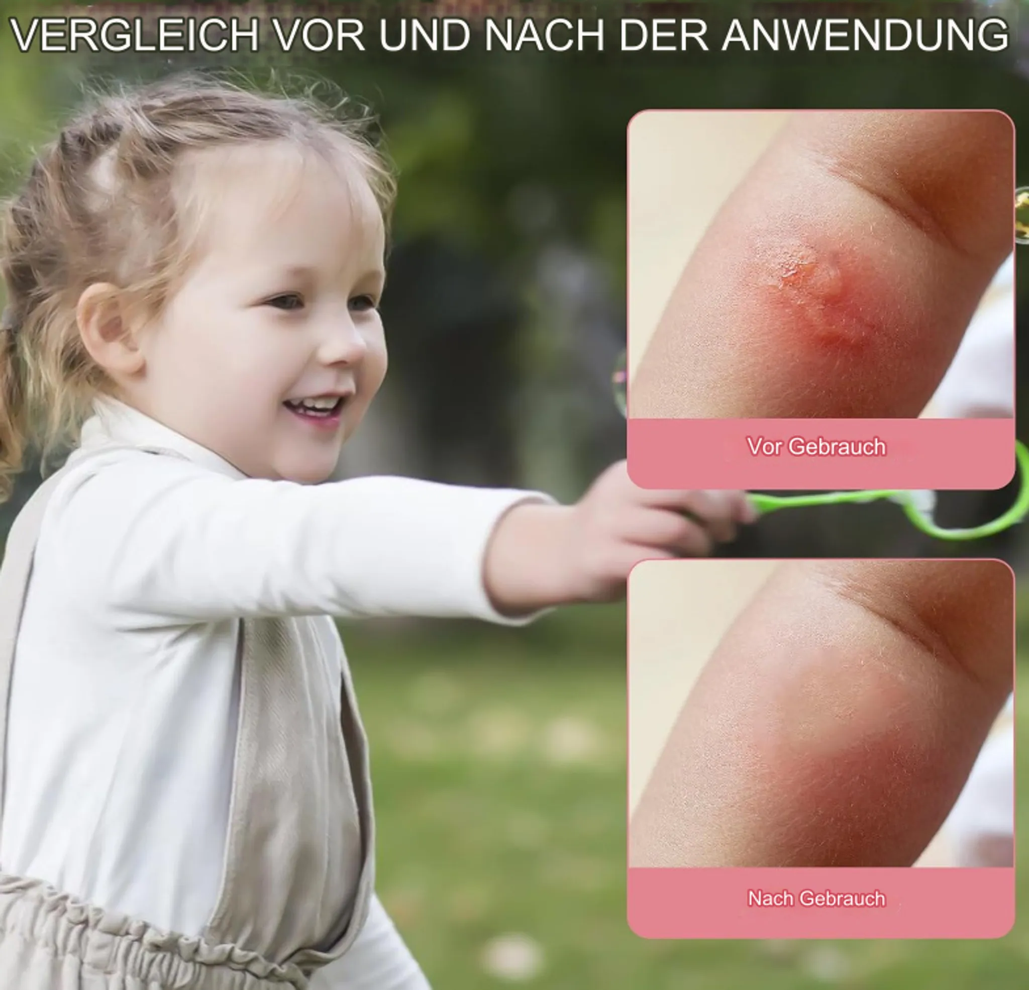 Der Arm eines Kindes mit Vorher-Nachher-Bildern eines Mückenstichs, die die Rötungsreduzierung zeigen.