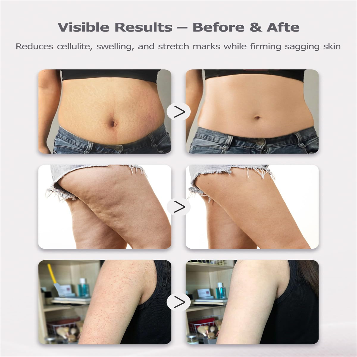Bild zeigt Vorher-Nachher-Ergebnisse. Reduzierung von Cellulite und Dehnungsstreifen und Straffung der Haut. Vier Bilder werden angezeigt.