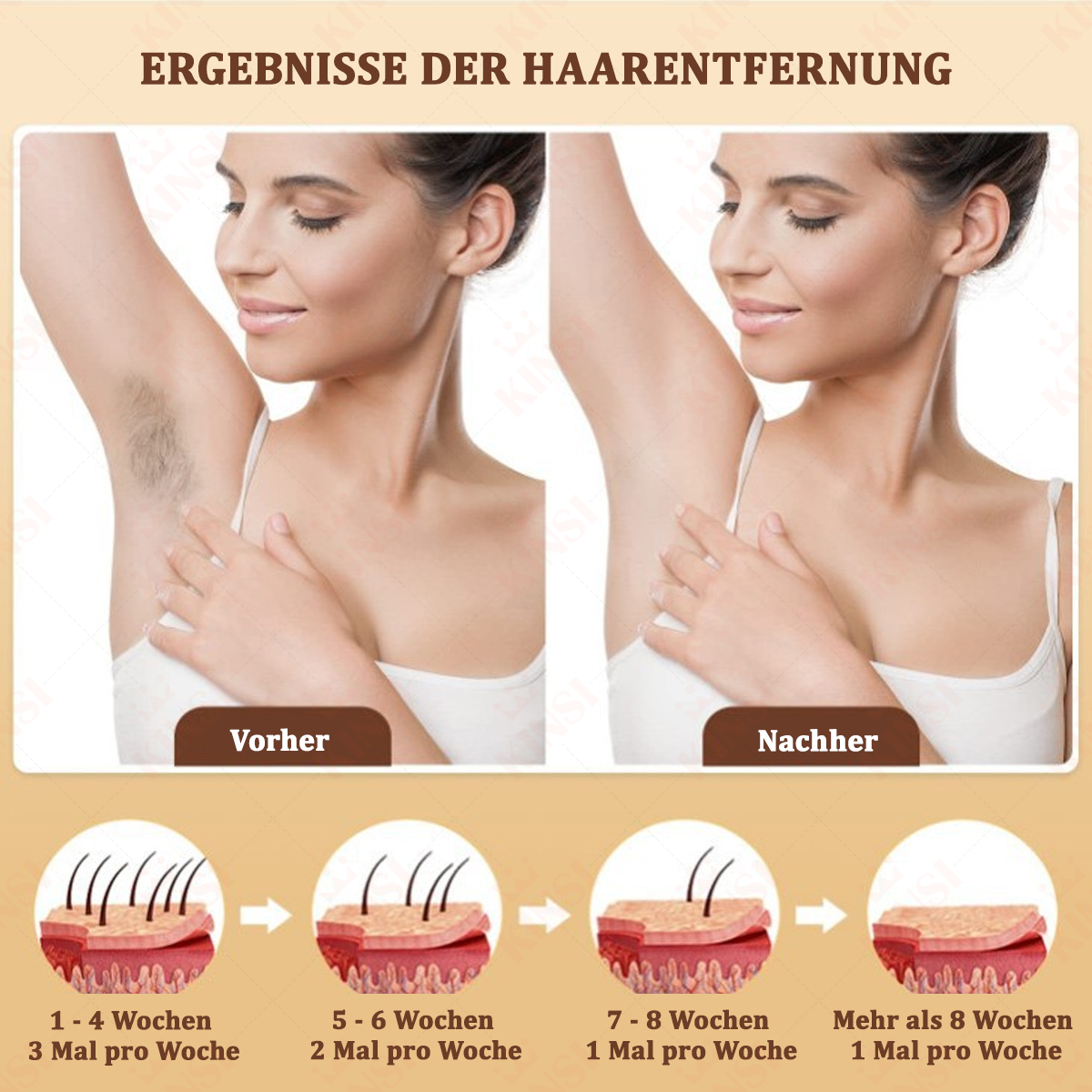 Bild zeigt Ergebnisse der Haarentfernung. Achsel mit Haaren, dann haarfrei. Hautdiagramme folgen.